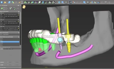 3D implant used for dental procedures.